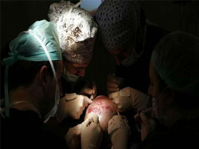 Mumbai businessman dies 40 hours after getting hair transplant